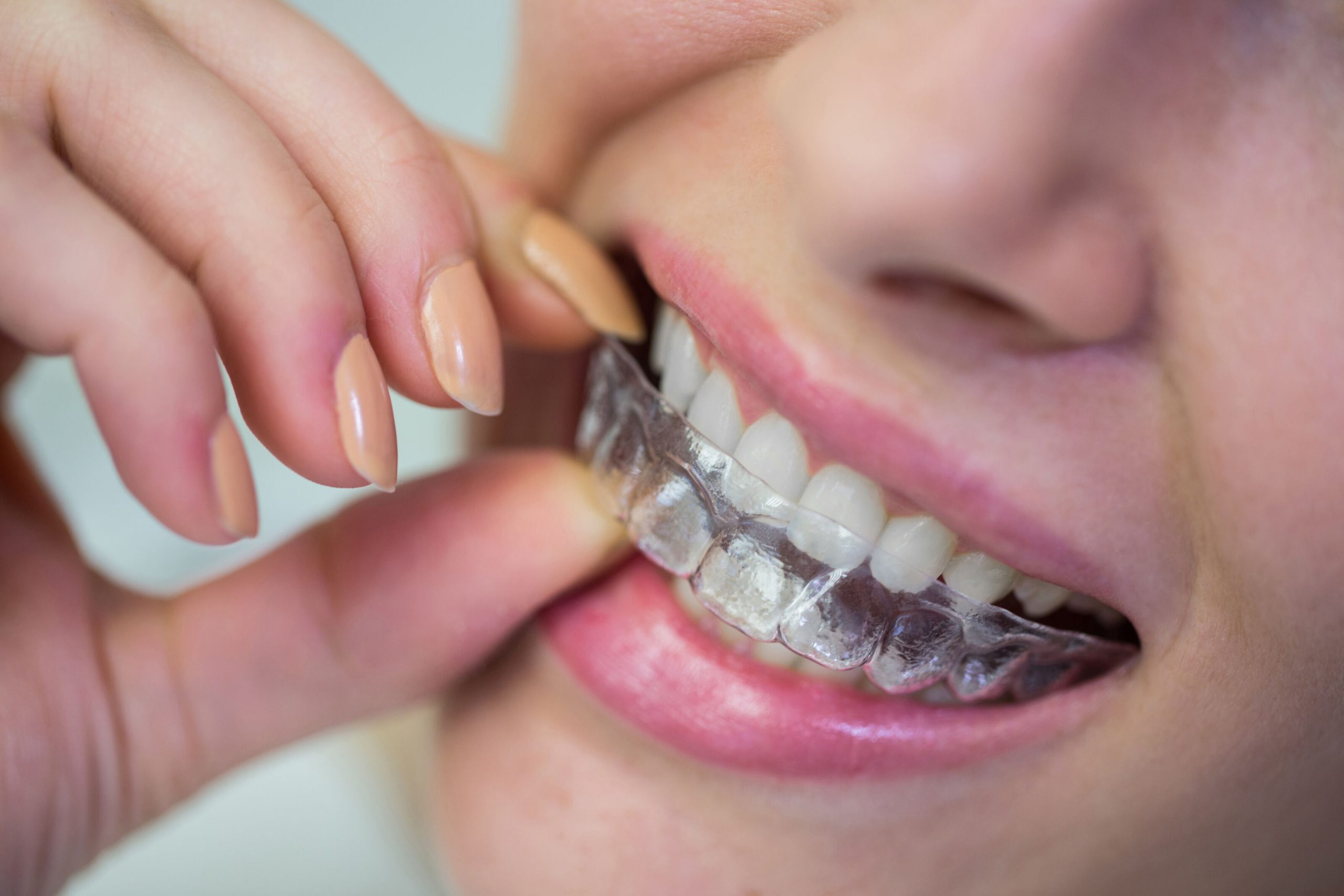 How Do I Know if Invisalign Is the Right Choice for My Smile?