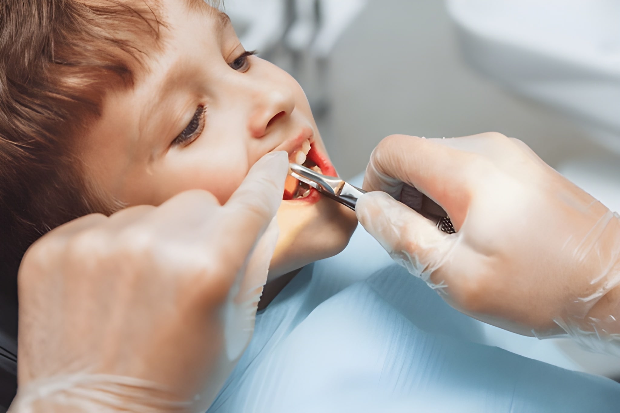 What Actually Happens During a Tooth Extraction Procedure?