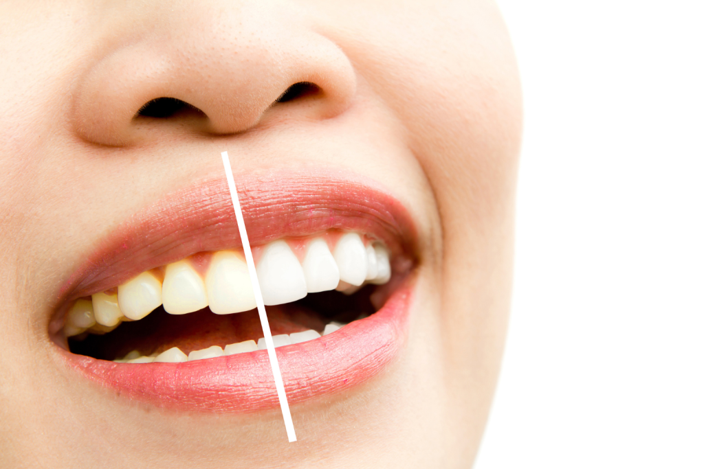 Teeth Cleaning vs Teeth Whitening in Aveley